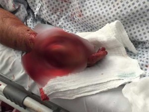 - Cuando se encontraba realizando labores de pesca, un hombre fue atacado por un tiburón blanco frente a las costas de Mazatlán, Sinaloa.